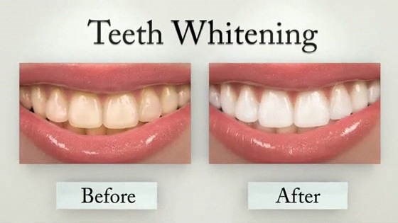 My Skills: Teeth Whitening Kits